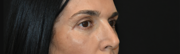 Eye Lift (Blepharoplasty) Case 5 - After