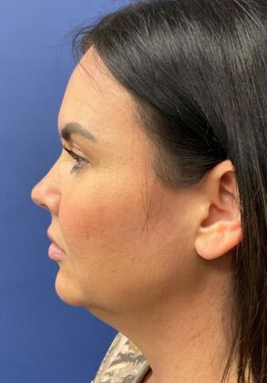 Chin Liposuction Case 1 - Before