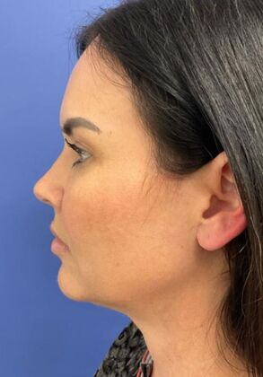 Chin Liposuction Case 1 - After