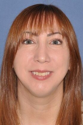 Rhinoplasty Revision Rhinoplasty with Rib Cartilage Grafts - After
