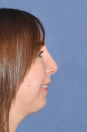 Rhinoplasty: Revision Rhinoplasty with Rib Cartilage Grafts - Before