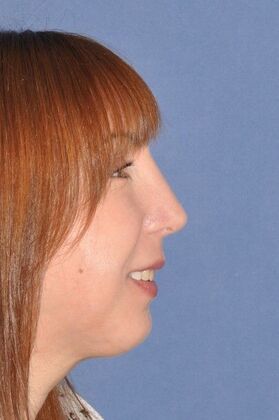 Rhinoplasty: Revision Rhinoplasty with Rib Cartilage Grafts - After
