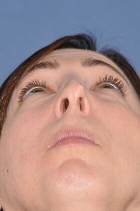 Rhinoplasty: Revision Rhinoplasty with Rib Cartilage Grafts - Before