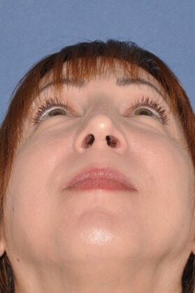 Rhinoplasty: Revision Rhinoplasty with Rib Cartilage Grafts - After