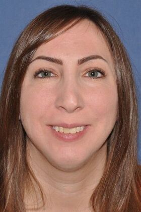 Rhinoplasty Revision Rhinoplasty with Rib Cartilage Grafts - Before