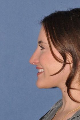 Rhinoplasty Rhinoplasty with bump removal - After