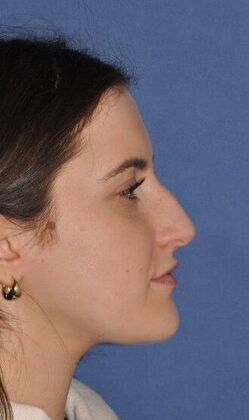 Rhinoplasty: Rhinoplasty with bump removal - Before