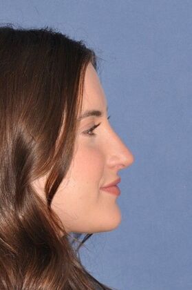 Rhinoplasty: Rhinoplasty with bump removal - After