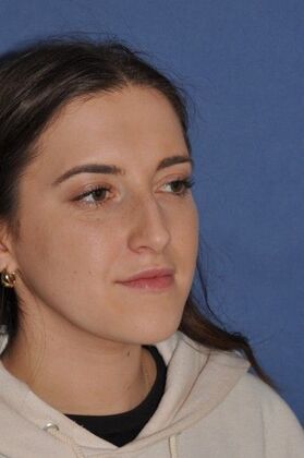 Rhinoplasty: Rhinoplasty with bump removal - Before