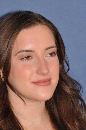 Rhinoplasty: Rhinoplasty with bump removal - After