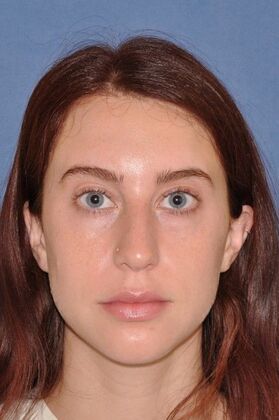 Rhinoplasty Lovely woman with minor tension nose - Before