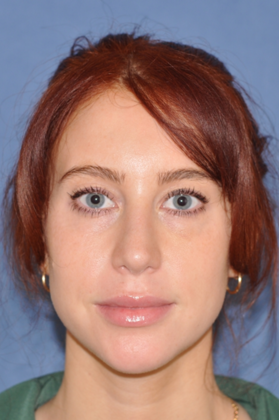 Rhinoplasty Lovely woman with minor tension nose - After