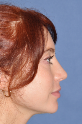 Rhinoplasty: Lovely woman with minor tension nose - After