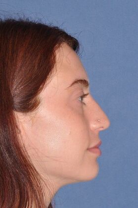 Rhinoplasty: Lovely woman with minor tension nose - Before