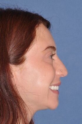 Rhinoplasty: Lovely woman with minor tension nose - Before