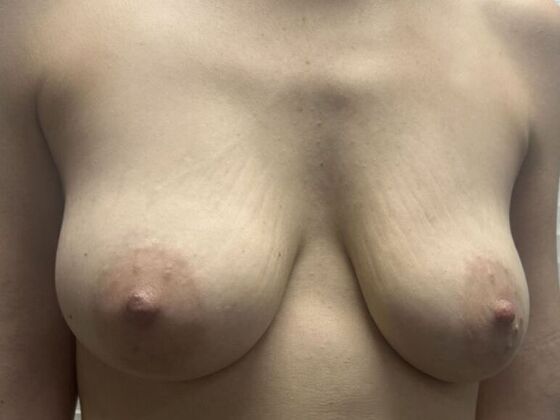 Breast Lift (Mastopexy): Case 279 - Before
