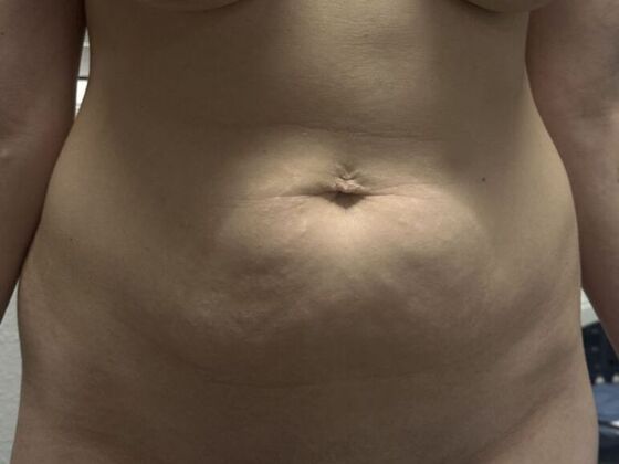 Tummy Tuck (Abdominoplasty): Case 599 - Before