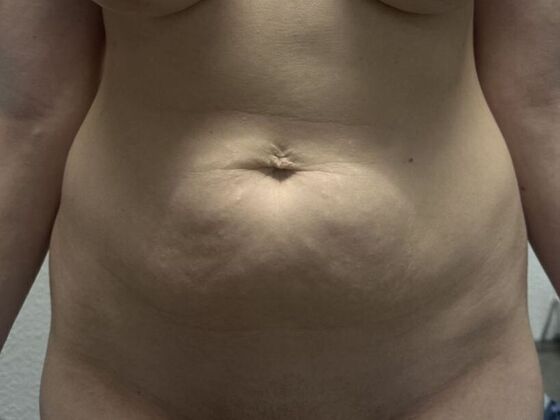 Tummy Tuck (Abdominoplasty): Case 599 - Before