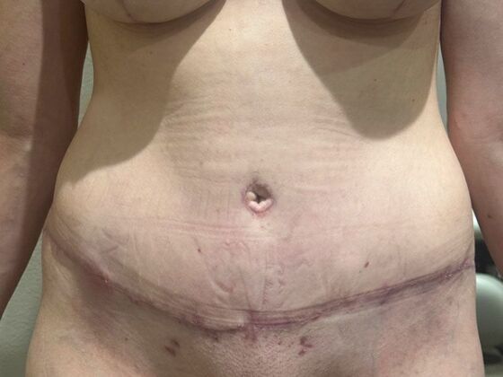 Tummy Tuck (Abdominoplasty): Case 599 - After
