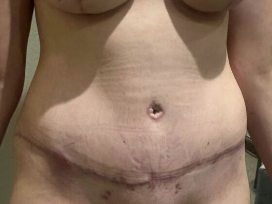 Tummy Tuck (Abdominoplasty): Case 599 - After