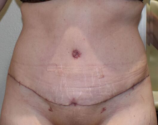 Tummy Tuck (Abdominoplasty): Case 600 - After