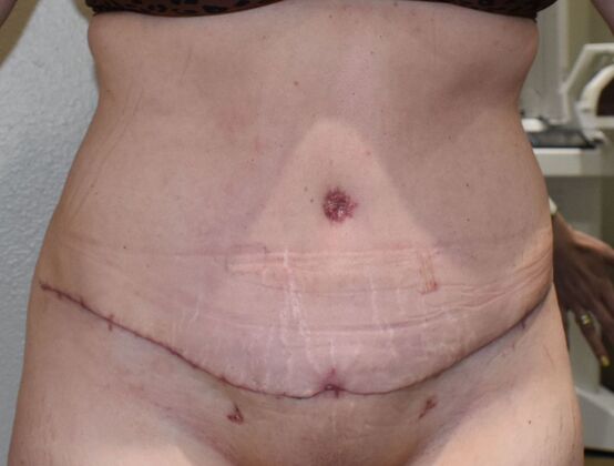 Tummy Tuck (Abdominoplasty): Case 600 - After