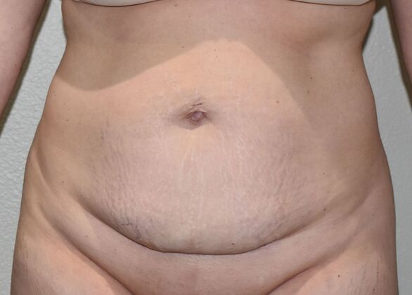 Tummy Tuck (Abdominoplasty): Case 600 - Before