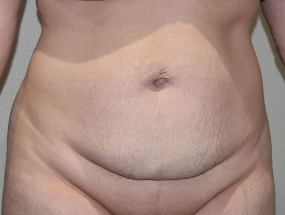 Tummy Tuck (Abdominoplasty): Case 600 - Before