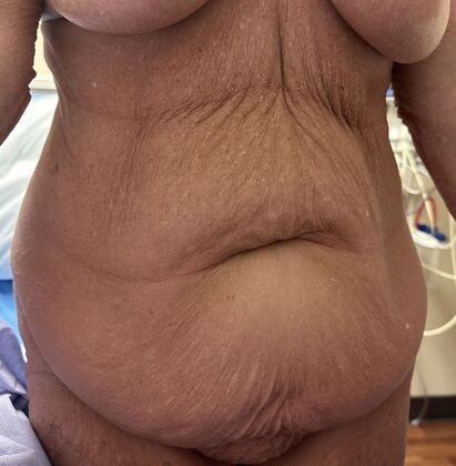 Massive Weight Loss : Case 10 - Before