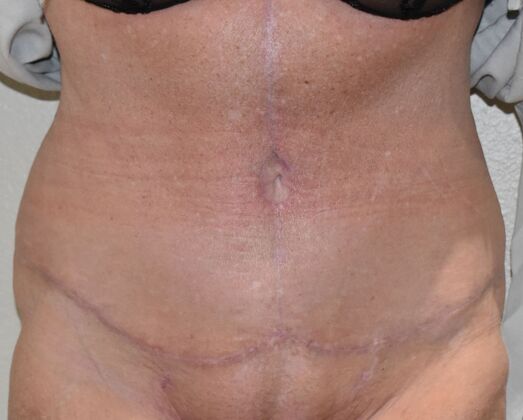 Massive Weight Loss  Case 10 - After