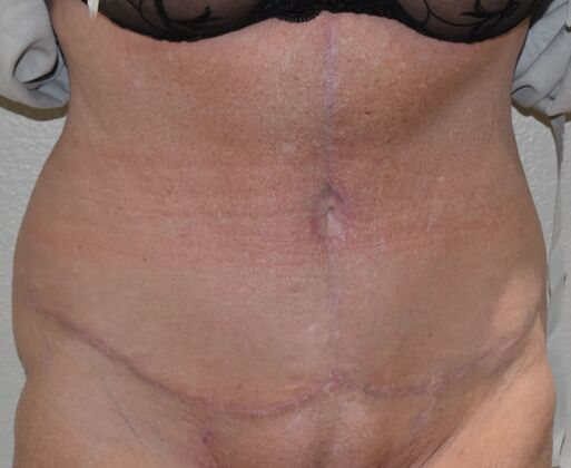 Massive Weight Loss : Case 10 - After