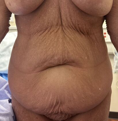 Tummy Tuck (Abdominoplasty): Case 601 - Before