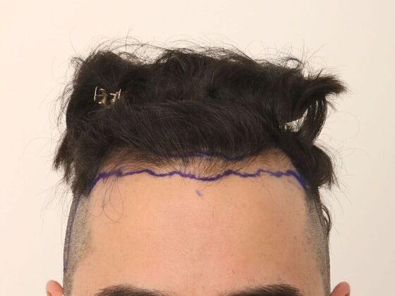 Hair Transplant - Male Hairline FUE - Case 24 - Before