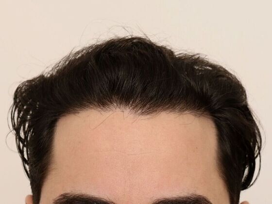 Hair Transplant - Male Hairline FUE - Case 24 - After