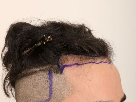 Hair Transplant - Male: Hairline FUE - Case 24 - Before FUE hair transplant