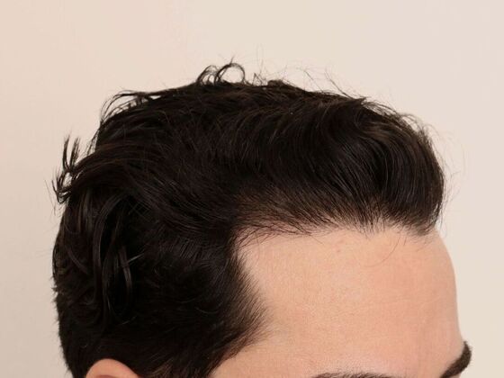 Hair Transplant - Male: Hairline FUE - Case 24 - After male FUE hair transplant
