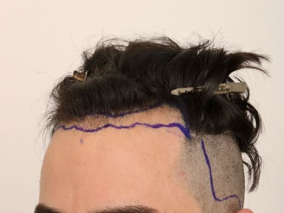 Hair Transplant - Male: Hairline FUE - Case 24 - Before FUE hair transplant