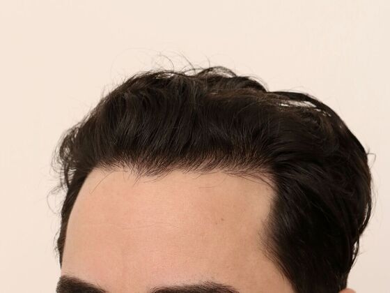 Hair Transplant - Male: Hairline FUE - Case 24 - After male FUE hair transplant