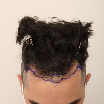 Hair Transplant - Male: Hairline FUE - Case 24 - Before FUE hair transplant