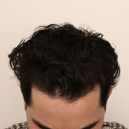 Hair Transplant - Male: Hairline FUE - Case 24 - After male FUE hair transplant