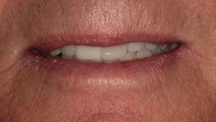 Porcelain Crowns: Case 2 - Before