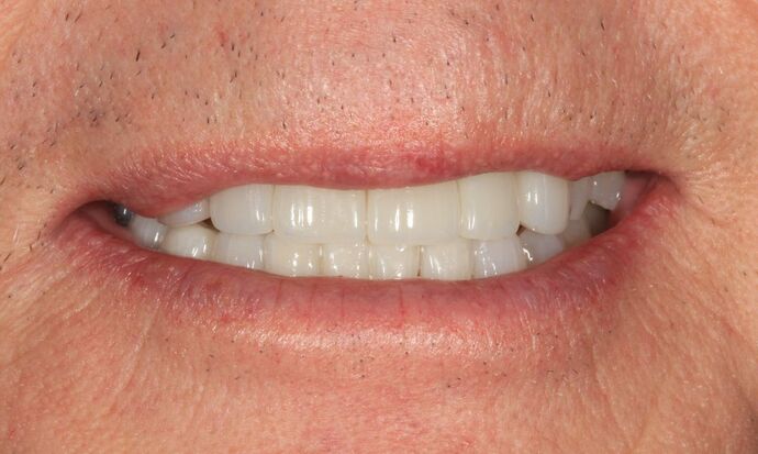 Porcelain Crowns: Case 2 - After
