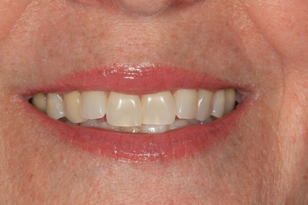 Dental Implants Case 17 - Before