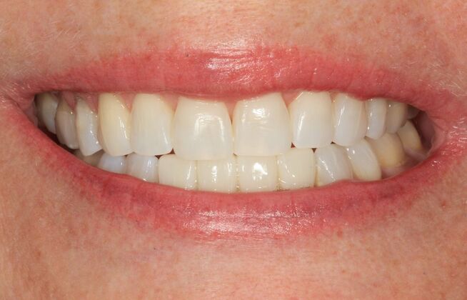 Dental Implants Case 17 - After