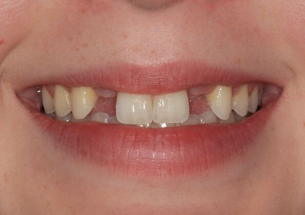 Dental Implants Case 18 - Before