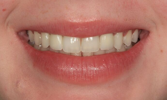 Dental Implants Case 18 - After
