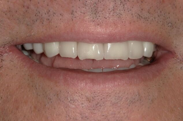 Full Mouth Reconstruction: Case 53 - Before