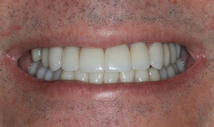 Full Mouth Reconstruction: Case 53 - After