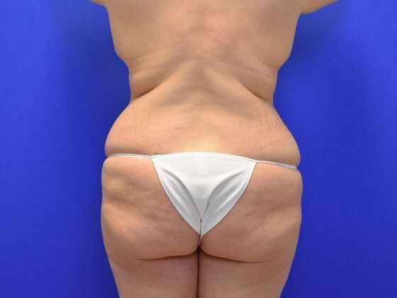 Torsoplasty Case 2 - Before