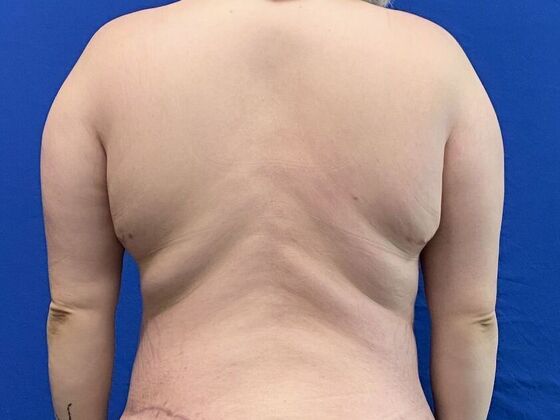 Torsoplasty: Case 2 - Before